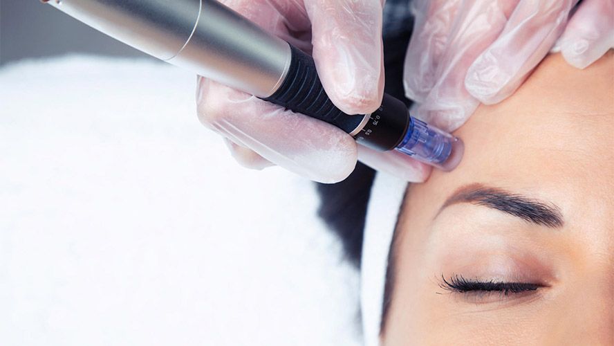 Skin resurfacing con Laser CO₂ frazionato