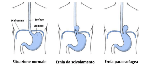 Ernia Iatale La Causa Del Reflusso 